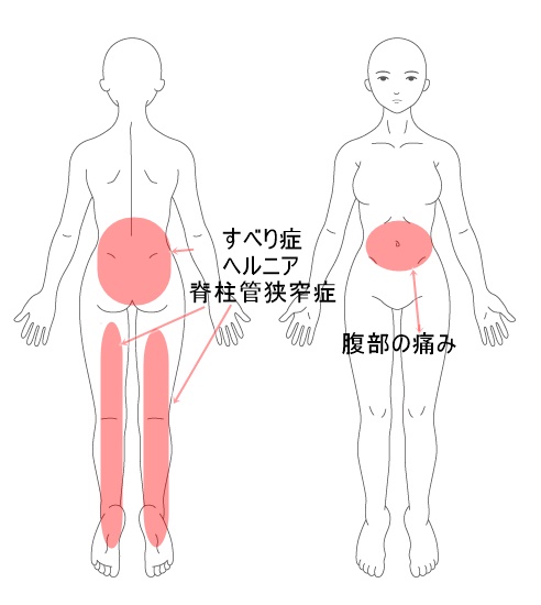 すべり症　腰椎椎間板ヘルニア　脊柱管狭窄症